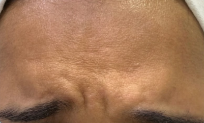 قبل علاج التجاعيد